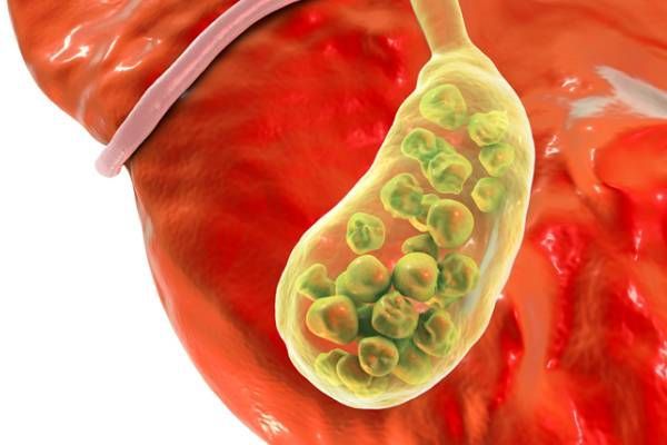 Gallbladder Surgery