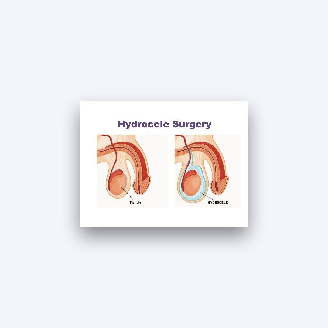 Hydrocele Surgery