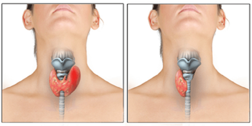 Cancer Surgery in Chennai
